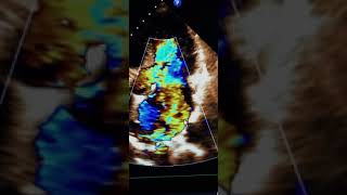 Mitral valve prolapse of the posterior leaflet see description [upl. by Ssitnerp]