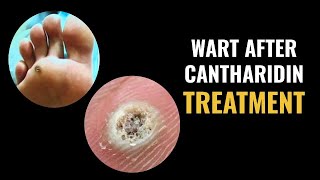 Wart After Cantharidin Treatment [upl. by Shamrao]