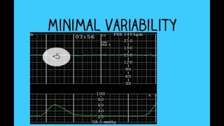 Topic 26 Intrapartum Fetal Surveillance [upl. by Soigroeg787]