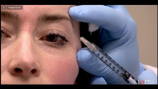 UNDER EYE BOTOX Experience amp Footage  BeforeAfter Cost Pain Bruising [upl. by Brause912]