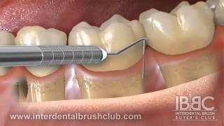 Periodontal disease causes and treatment [upl. by Whitelaw]