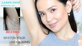 The TRUTH About Laser Hair Removal My Experience  How to lighten underarms [upl. by Thoma]