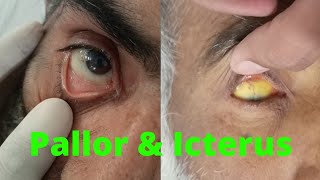 PALLOR and ICTERUS in EYE  ANEMIA and JAUNDICE in eye examination [upl. by Llenehs]