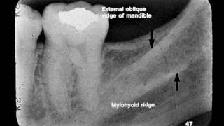 Dental Radiographic Anatomy [upl. by Sorcim]