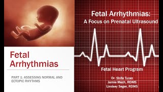 FETAL ARRHYTHMIAS Part One  Assessing Normal and Ectopic Rhythms [upl. by Enoj549]