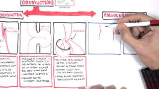 Bowel Obstruction  Causes and Pathophysiology [upl. by Neliac]