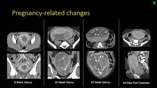 Gynecologic Radiology Anatomy [upl. by Eemia]