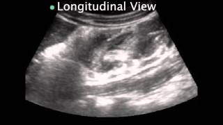 Pediatric Intussusception [upl. by Annis]