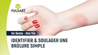 Identifier et soulager une brûlure simple [upl. by Ahsiakal44]