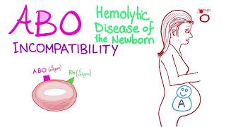 ABO Incompatibility  Hemolytic Disease Of The Newborn HDN  Hematology amp Pathology [upl. by Flanders299]