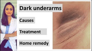 How to get rid of Dark underarms  causes treatment home remedy Dermatologist  Dr Aanchal [upl. by Latrell]