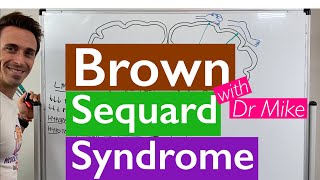 Brown Sequard Syndrome [upl. by Macswan959]