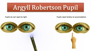 Argyll Robertson Pupil [upl. by Yeca]