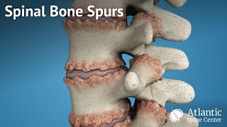 Spinal Bone Spurs [upl. by Acirdna]