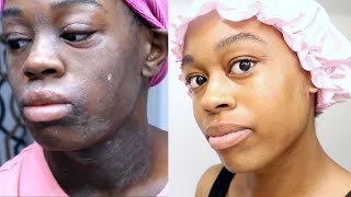 HOW I GOT RID OF DARK SPOTS BRIGHTEN DULL SKIN  HYPERPIGMENTATION [upl. by Nnateragram]