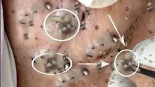 Best Pimple Popping Videos 2021  Blackheads Removal 021 [upl. by Grissel671]