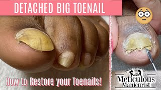 How To Pedicure Transformation for Men on Detached Toenails [upl. by Nilpik]