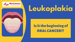 ENT 359 a Leukoplakia Keratosis Larynx PreMalignant lesion vocal cord precancerous [upl. by Lumbye81]