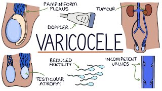 Varicocele Surgery What to Expect [upl. by Oinoitna386]