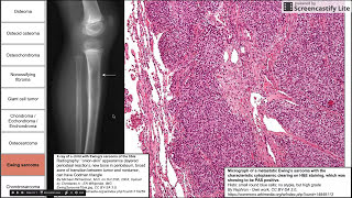 Bone and cartilage tumors [upl. by Treblih]