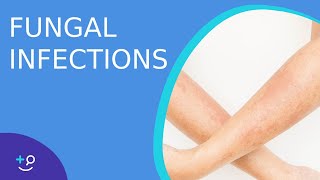 Fungal Infections  Causes Prevention and Cure [upl. by Pia486]