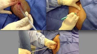 Chest Tube Placement [upl. by Gerianne]