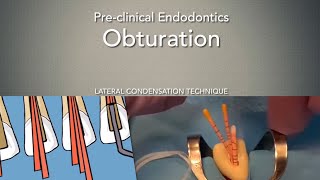 Obturation Lateral Condensation Technique [upl. by Nehgaem]