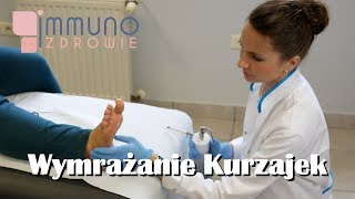 Wymrażanie Kurzajek Ciekłym Azotem Kriochirurgia [upl. by Azne]