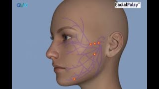 Understanding Facial Palsy [upl. by Aneram550]