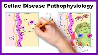 Celiac Disease and Gluten [upl. by Yrakaz360]