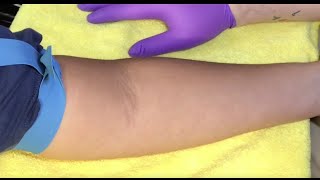 Tips For Locating Difficult Veins [upl. by Engelbert]