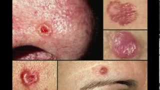 BASAL CELL SKIN CANCER WHAT YOU SHOULD KNOW DR DRAY [upl. by Oregolac]