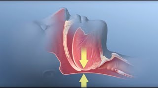 Central versus Obstructive Sleep Apnea Diagnosis and Management [upl. by Emlin]