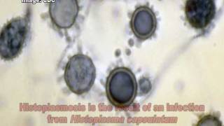 Histoplasma capsulatum amp Histoplasmosis [upl. by Enyleuqcaj821]