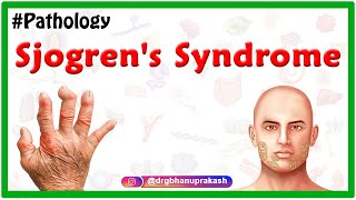 Systemic Sclerosis and Scleroderma Visual Explanation for Students [upl. by Iverson]