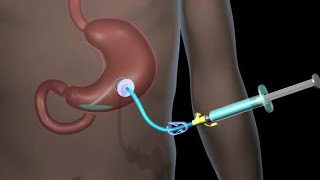 Understanding Tracheostomy Tubes National Tracheostomy Safety Project [upl. by Nosnej267]