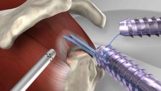 Knotless Rotator Cuff Repair with Arthrex® SpeedFix™ [upl. by Huskey775]